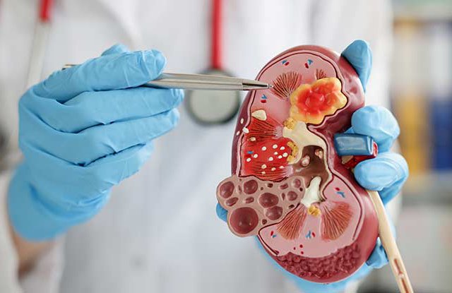 Böbrek Üstü Bezi Tümörleri